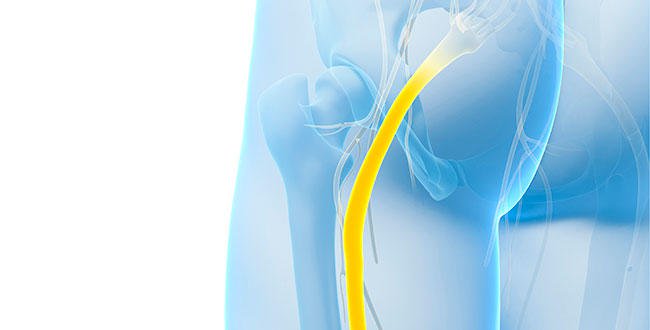 11 Effective Solutions For Sciatica Pain